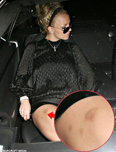 Bruises and a New Beau